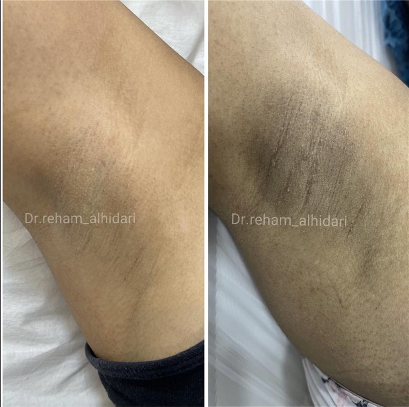 نتيجة قبل وبعد - تفتيح البشرة